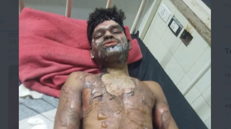 मध्य प्रदेश: केरोसिन उड़ेल दलित युवक को लगाई आग, पठान, कल्लू और इरफान गिरफ्तार