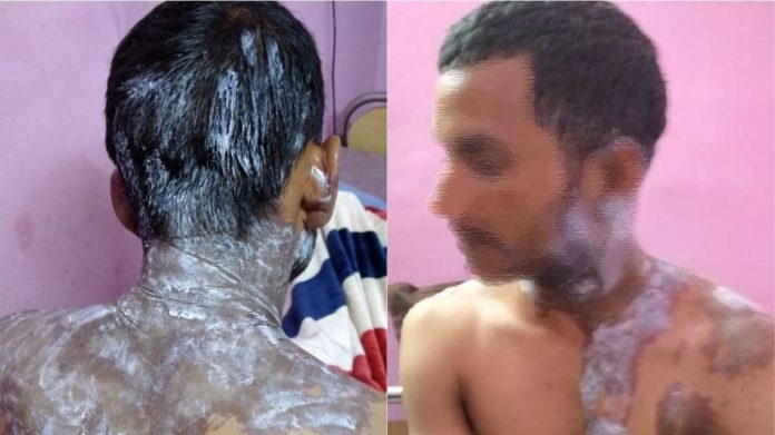 उन्नाव में युवक पर एसिड हमला