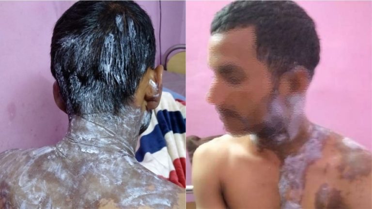एकतरफा इश्क में मुस्लिम लड़की ने हिंदू लड़के पर फेंका तेजाब, 5 महीने से कर रही थी पीछा