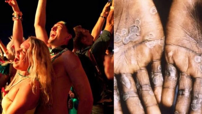 सेक्स, समलैंगिकों, WHO, मंकीपॉक्स