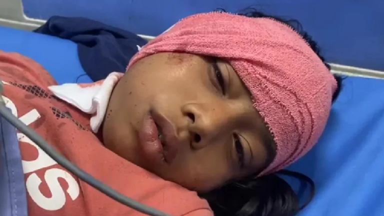 पिटबुल ने नोचे 9 साल की बच्ची के कान: पड़ोस की छत से कूद कर आया, चेहरे पर हमला किया; डॉक्टर बोले- ऑपरेशन करना पड़ेगा