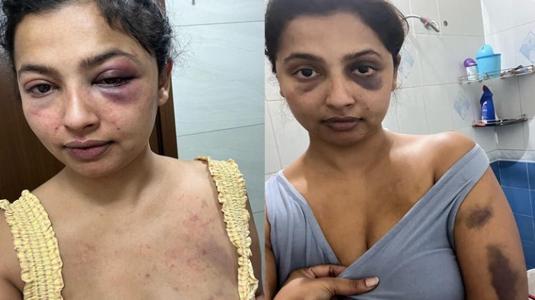 ‘ताबड़तोड़ मुक्के बरसाए, मुँह दबा दिया’: साउथ की हिरोइन ने चोटों के निशान वाली तस्वीरें शेयर की, कहा- एक्स बॉयफ्रेंड ने पीटा, अब मिल रही धमकी