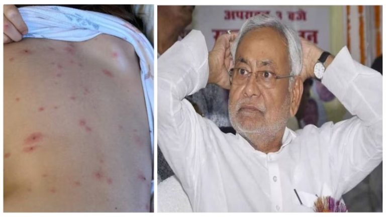 बिहार में 3 महीने से कहर बरपा रहा चेचक, मेडिकल टीम भेजने में लग गए 3 महीने: उधर ‘सियासी खेल’ में व्यस्त CM नीतीश कुमार