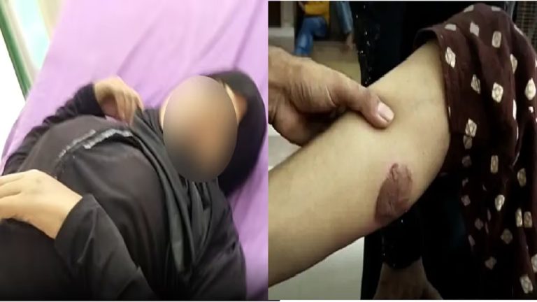 बीवी से अप्राकृतिक सेक्स करना चाहता था शौहर, नहीं मानी तो इस्त्री गर्म कर जला डाले दोनों कूल्हे: ट्रॉमा सेंटर में चल रहा इलाज